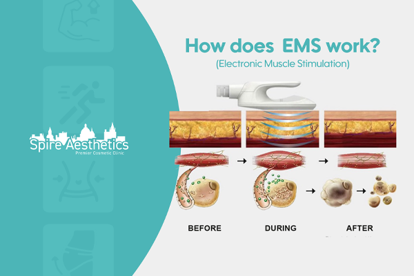 EMS treatment for post pregnancy weight loss treatment High Wycombe