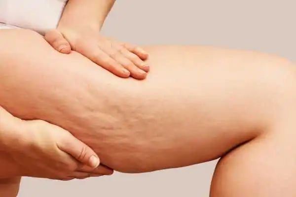 Image of woman showing leg with cellulite High Wycombe