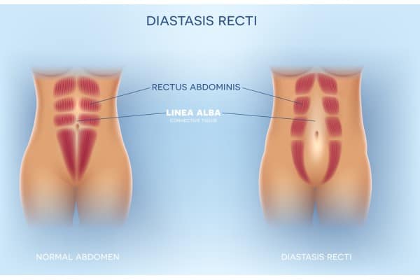 What Non-Surgical Options Are Available for Diastasis Recti High Wycombe?