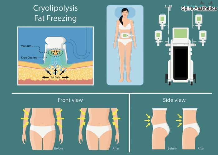 Image of diet and fat freezing combined for best results for Spire Aesthetics High Wycombe