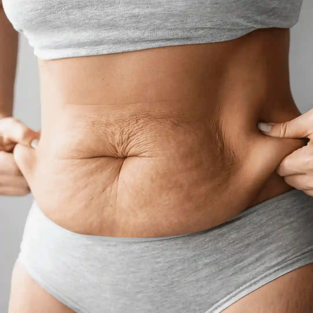 Is It Normal to Have Loose Skin After Pregnancy High Wycombe?