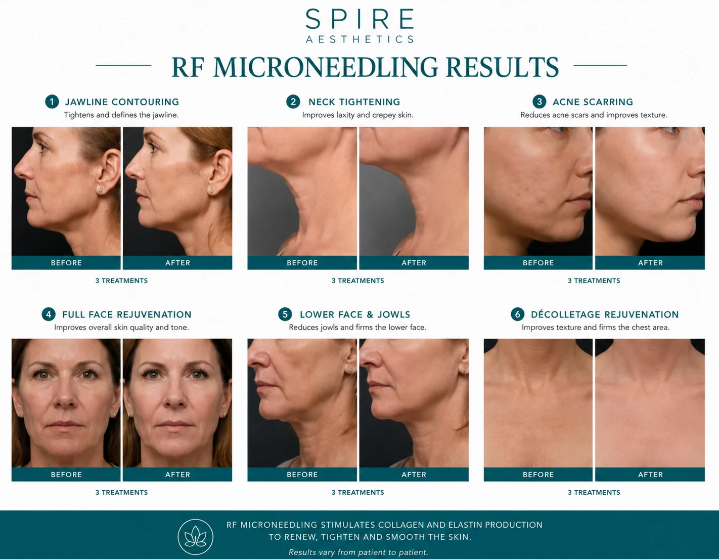 RF Microneedling Skin tightening High Wycombe results