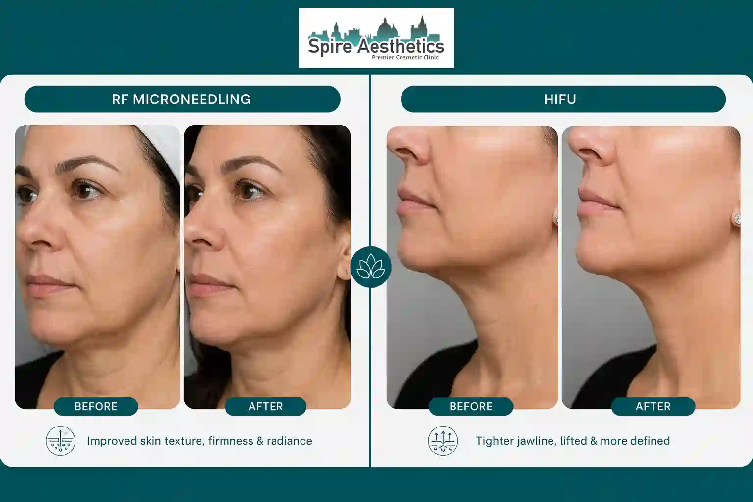 Can RF Microneedling and HIFU Be Combined High Wycombe?